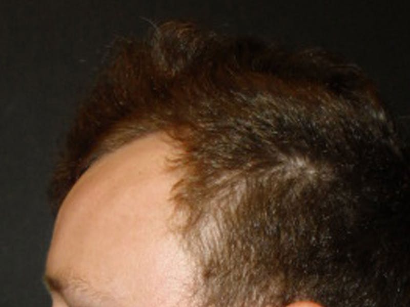 Hair Restoration Before & After Gallery - Patient 76073021 - Image 3