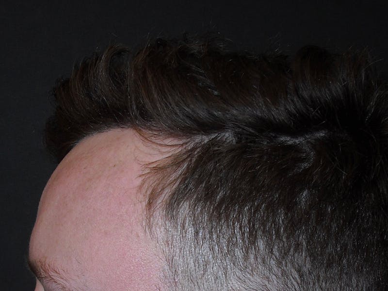 Hair Restoration Before & After Gallery - Patient 76073021 - Image 4