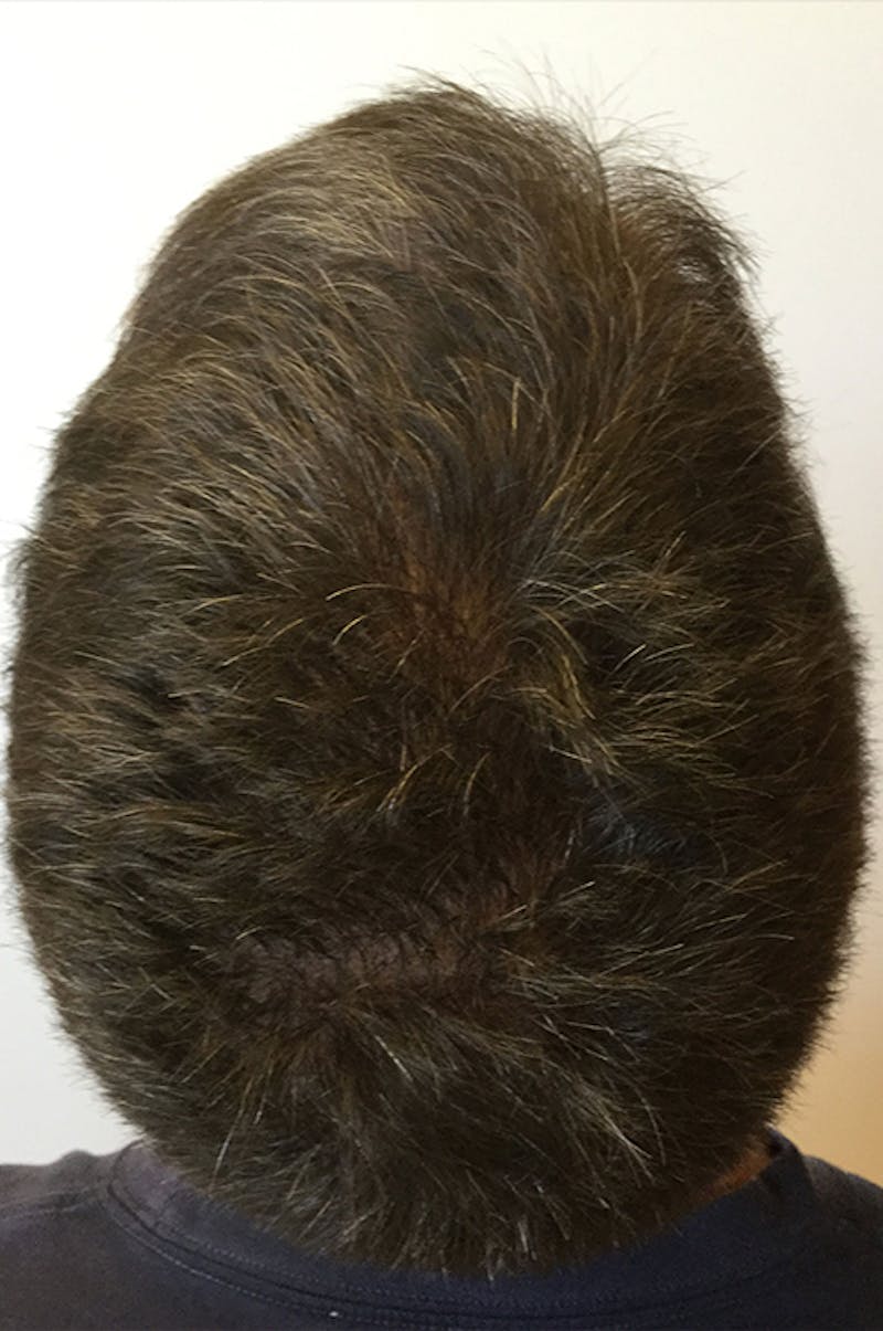 Hair Restoration Before & After Gallery - Patient 76073022 - Image 1
