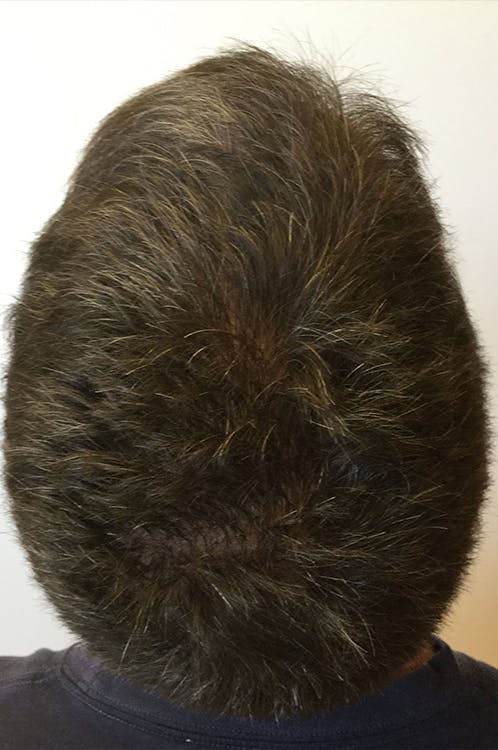 Hair Restoration Gallery - Patient 76073022 - Image 1