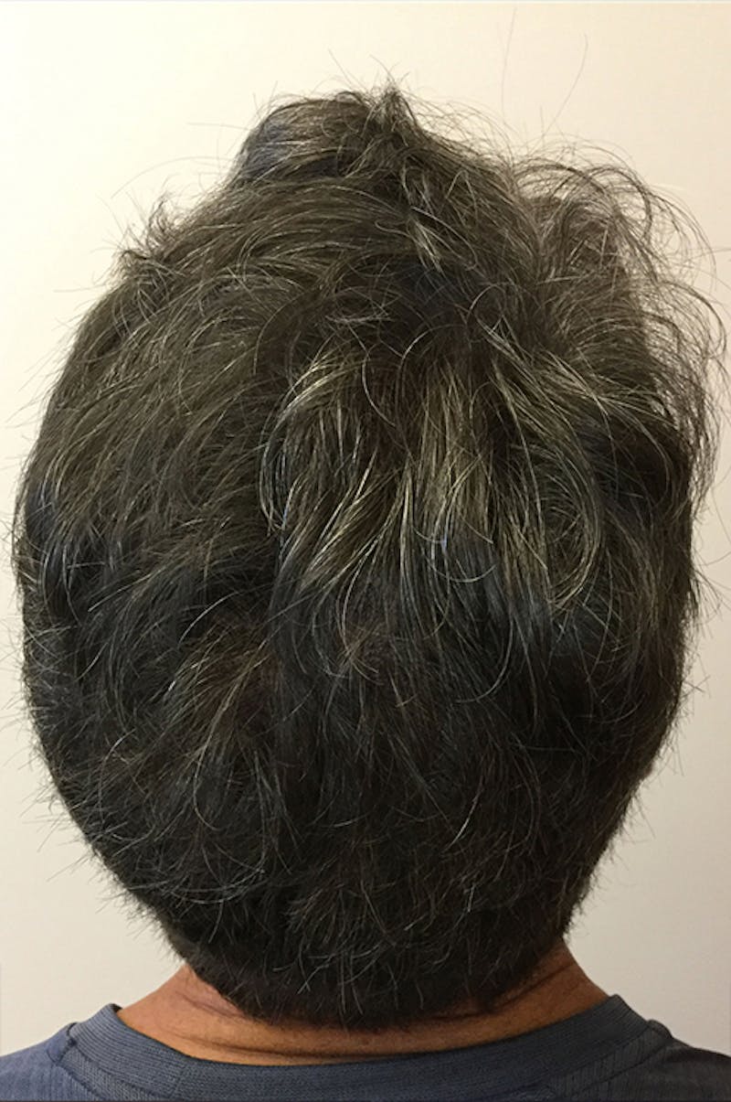 Hair Restoration Before & After Gallery - Patient 76073022 - Image 2