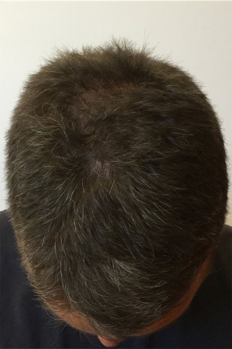Hair Restoration Before & After Gallery - Patient 76073022 - Image 3