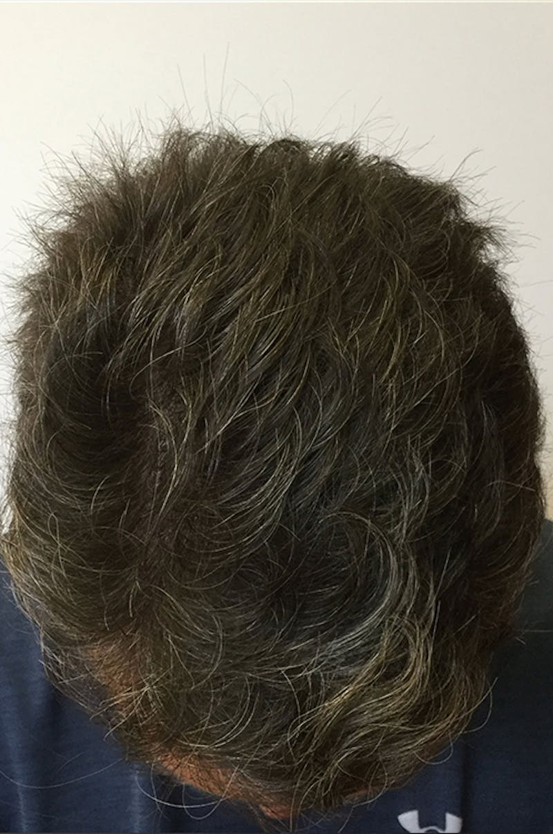 Hair Restoration Before & After Gallery - Patient 76073022 - Image 4