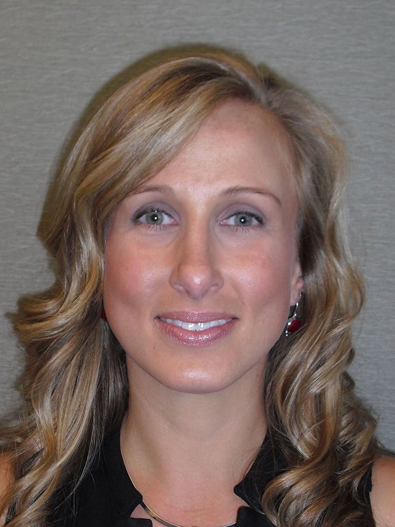 Rhinoplasty Before & After Gallery - Patient 81568823 - Image 4