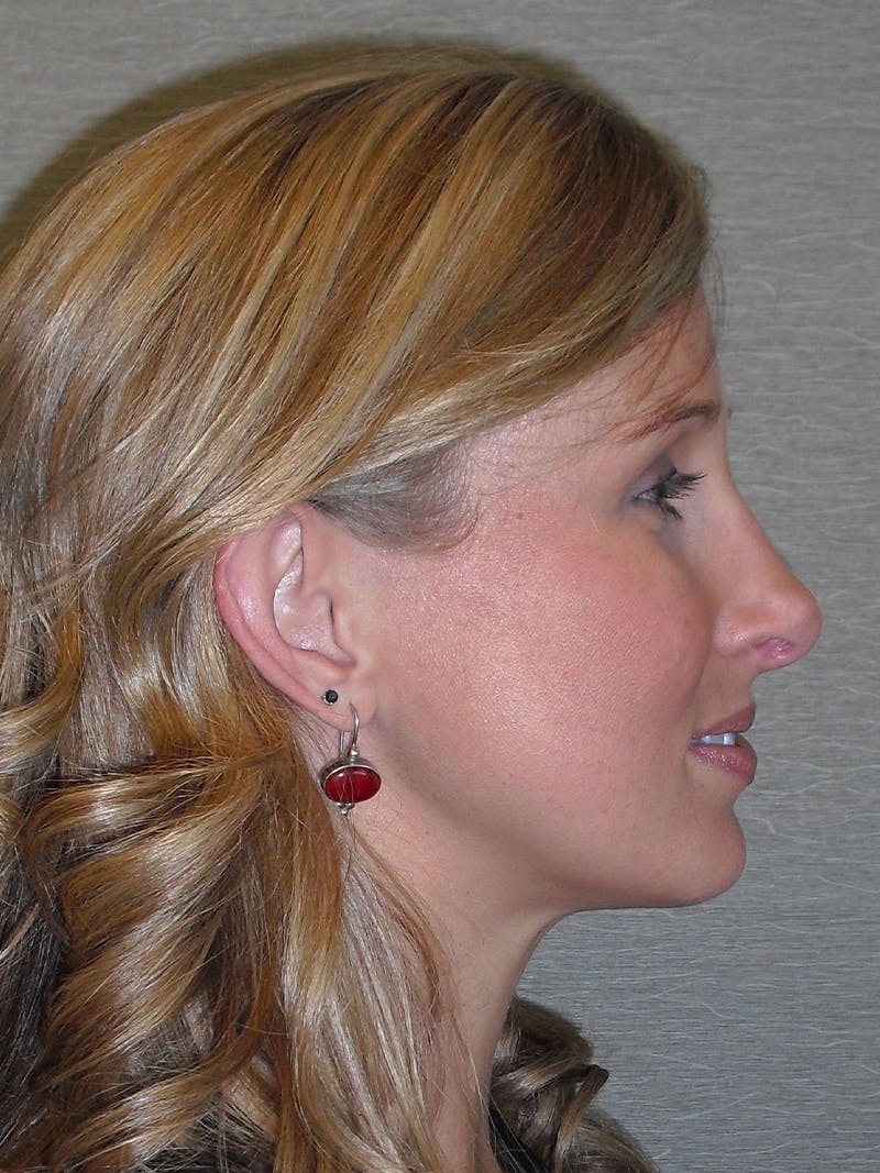 Rhinoplasty Before & After Gallery - Patient 81568823 - Image 2