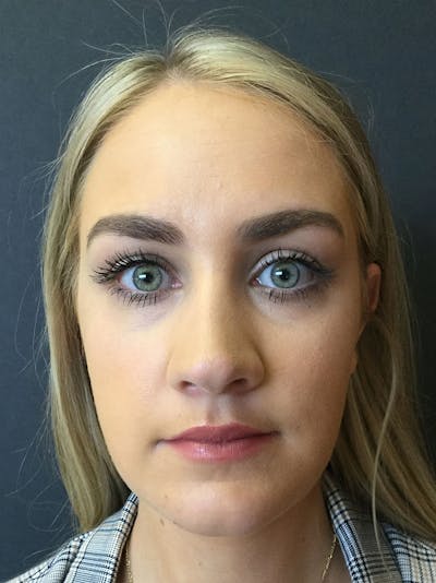 Rhinoplasty Before & After Gallery - Patient 81568824 - Image 2