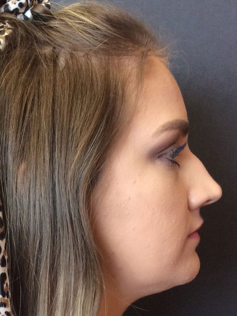 Rhinoplasty Before & After Gallery - Patient 81568824 - Image 3