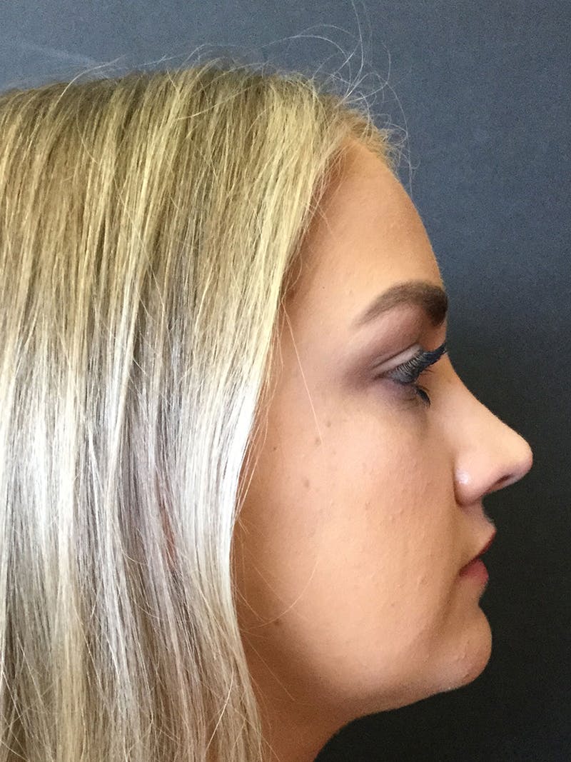 Rhinoplasty Before & After Gallery - Patient 81568824 - Image 4