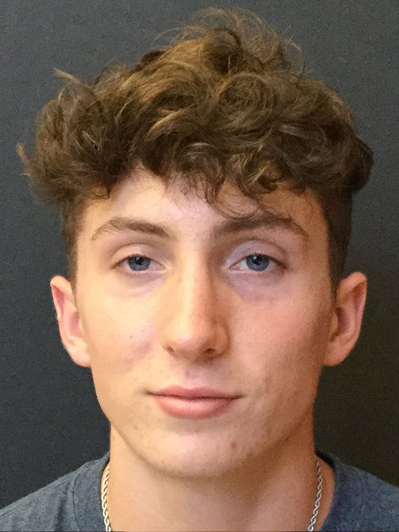 Rhinoplasty Before & After Gallery - Patient 81568825 - Image 4