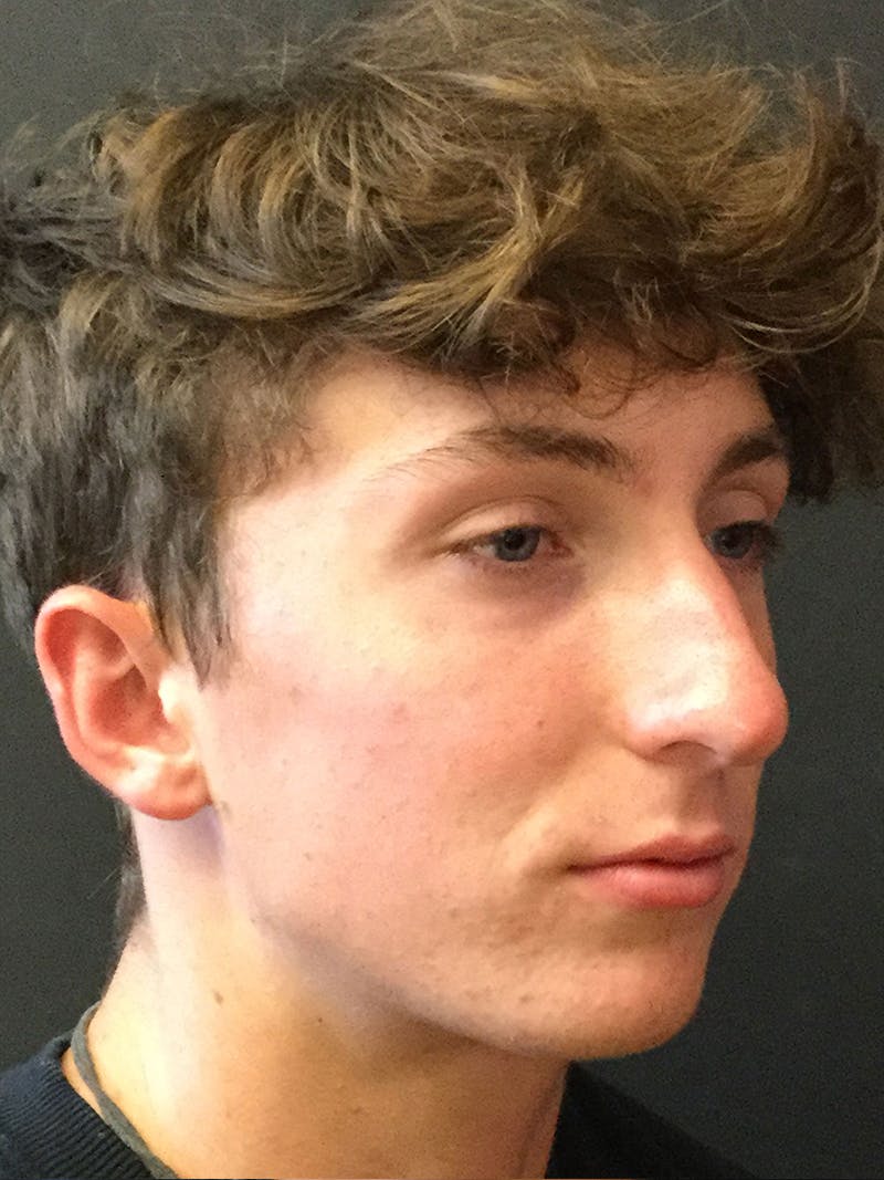 Rhinoplasty Before & After Gallery - Patient 81568825 - Image 1