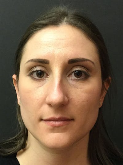 Rhinoplasty Before & After Gallery - Patient 81568826 - Image 1