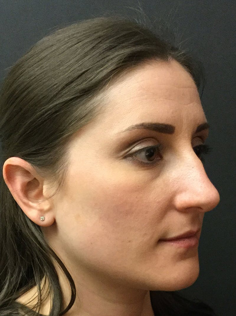 Rhinoplasty Before & After Gallery - Patient 81568826 - Image 3