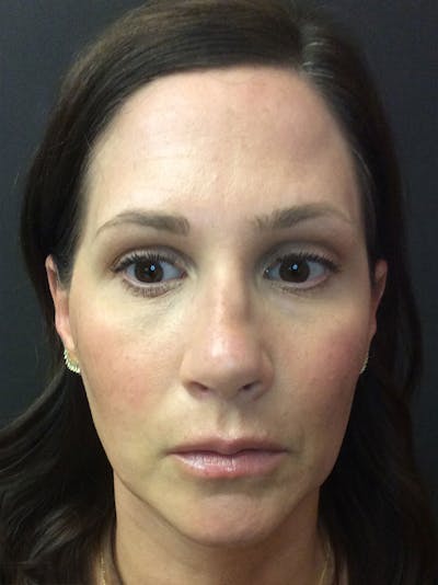 Rhinoplasty Before & After Gallery - Patient 81568827 - Image 1