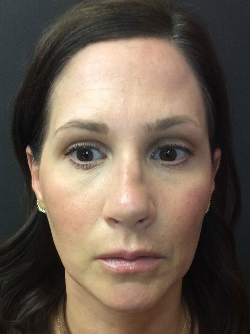 Rhinoplasty Before & After Gallery - Patient 81568827 - Image 3