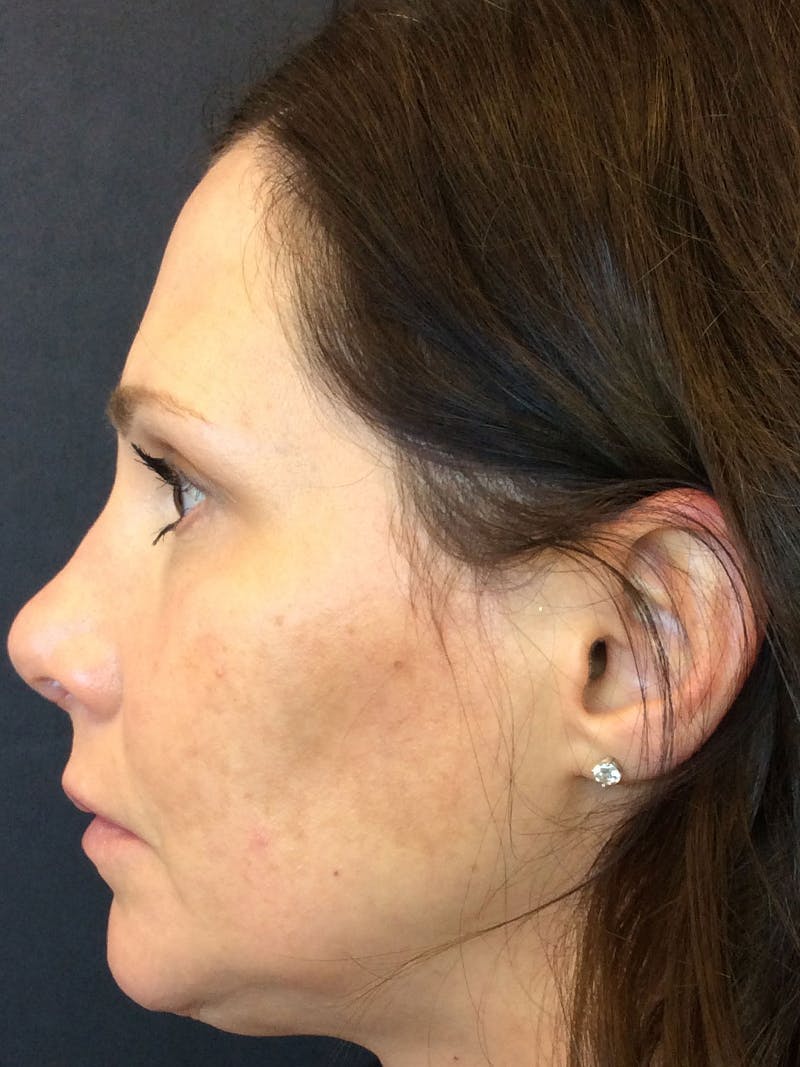 Rhinoplasty Before & After Gallery - Patient 81568827 - Image 3