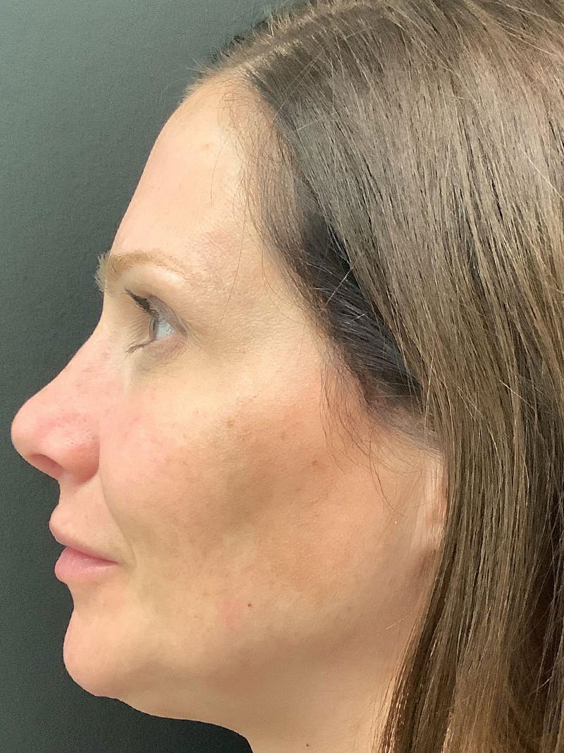 Rhinoplasty Before & After Gallery - Patient 81568827 - Image 4