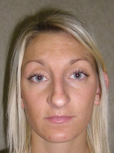 Rhinoplasty Before & After Gallery - Patient 81568828 - Image 1
