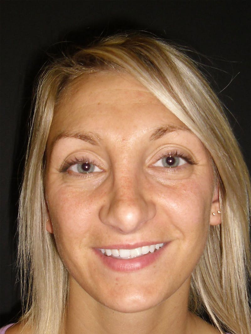 Rhinoplasty Before & After Gallery - Patient 81568828 - Image 4