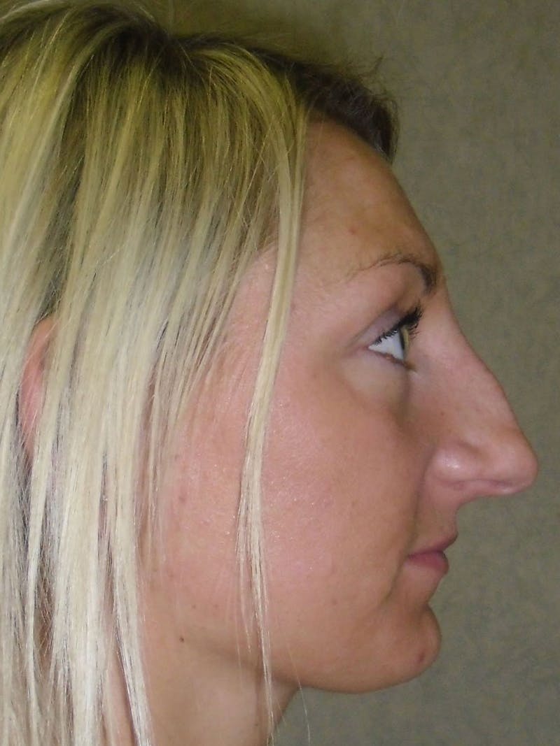Rhinoplasty Before & After Gallery - Patient 81568828 - Image 3
