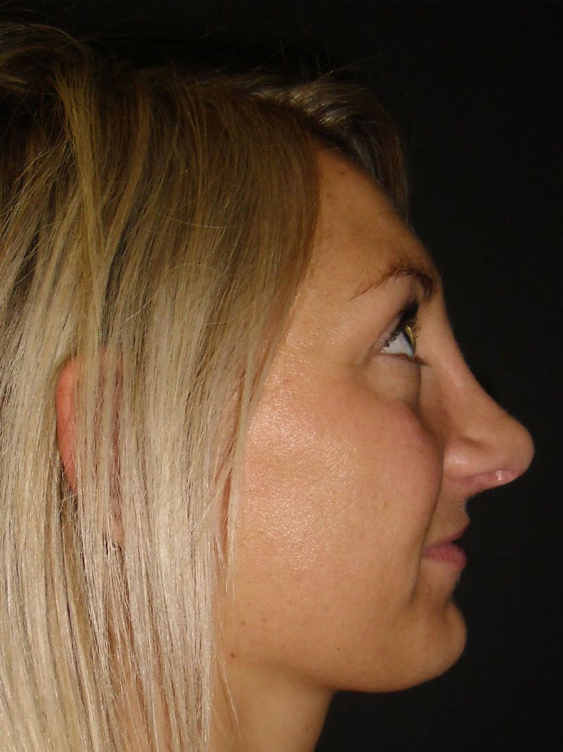 Rhinoplasty Before & After Gallery - Patient 81568828 - Image 4