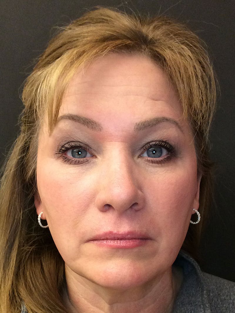 Rhinoplasty Before & After Gallery - Patient 81568829 - Image 4