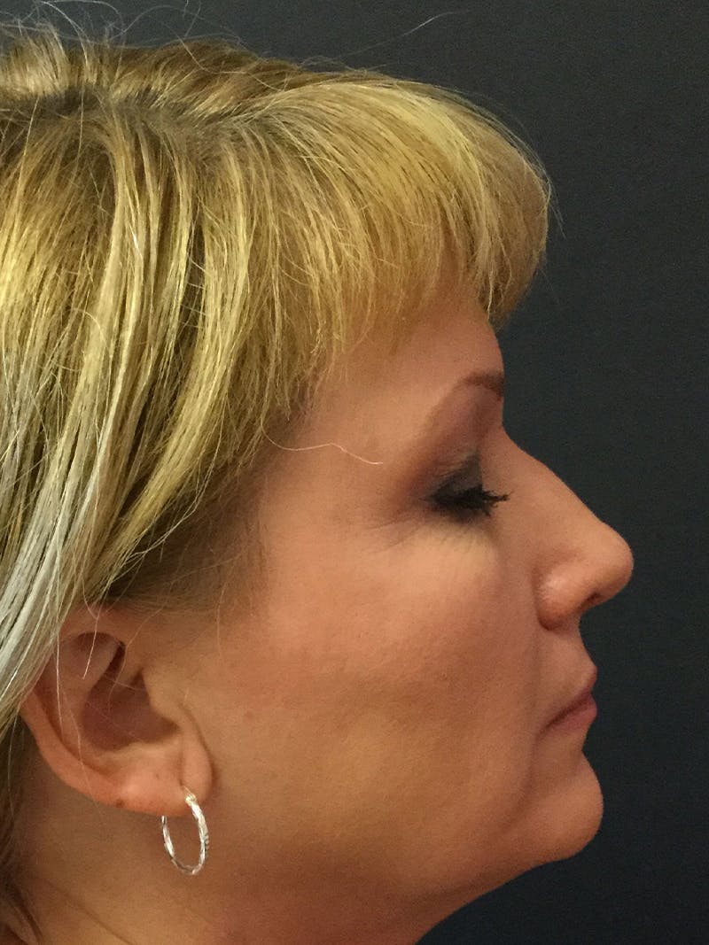 Rhinoplasty Before & After Gallery - Patient 81568829 - Image 3
