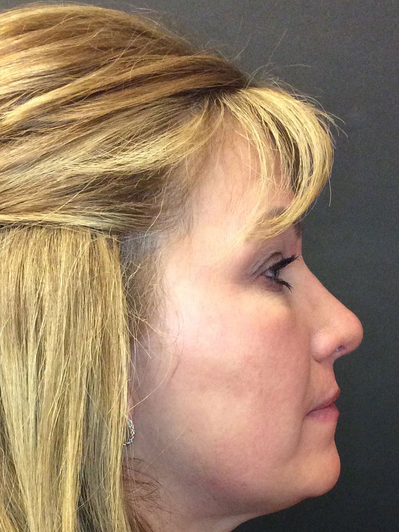 Rhinoplasty Before & After Gallery - Patient 81568829 - Image 4