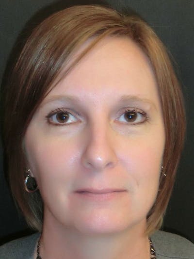 Chin Augmentation Before & After Gallery - Patient 86254714 - Image 1