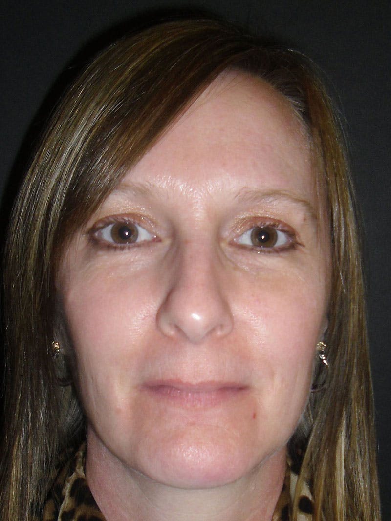Chin Augmentation Gallery - Patient 86254714 - Image 2