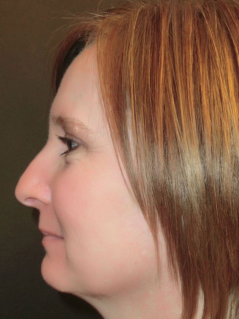 Chin Augmentation Before & After Gallery - Patient 86254714 - Image 3
