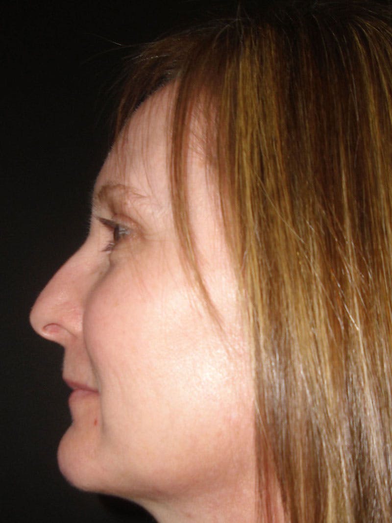 Chin Augmentation Before & After Gallery - Patient 86254714 - Image 4