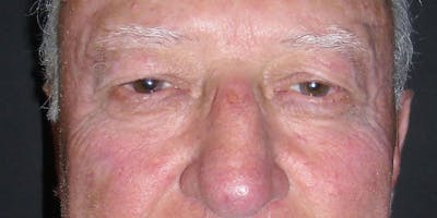 Eyelid Surgery Before & After Gallery - Patient 87850541 - Image 1