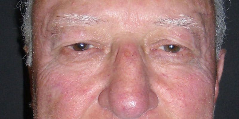 Eyelid Surgery Before & After Gallery - Patient 87850541 - Image 1