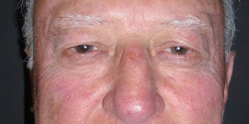 Eyelid Surgery Gallery - Patient 87850541 - Image 1