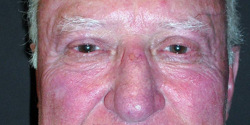 Eyelid Surgery Gallery - Patient 87850541 - Image 2