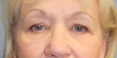 Eyelid Surgery Before & After Gallery - Patient 87850542 - Image 1