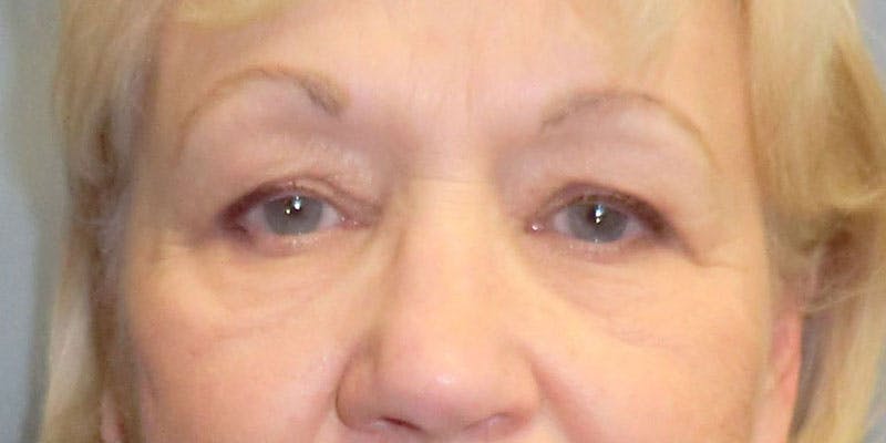 Eyelid Surgery Before & After Gallery - Patient 87850542 - Image 1