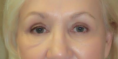 Eyelid Surgery Before & After Gallery - Patient 87850542 - Image 2