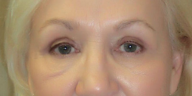 Eyelid Surgery Before & After Gallery - Patient 87850542 - Image 2