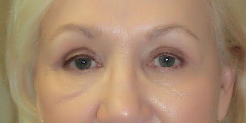Eyelid Surgery Gallery - Patient 87850542 - Image 2