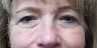 Eyelid Surgery Gallery - Patient 87850543 - Image 1