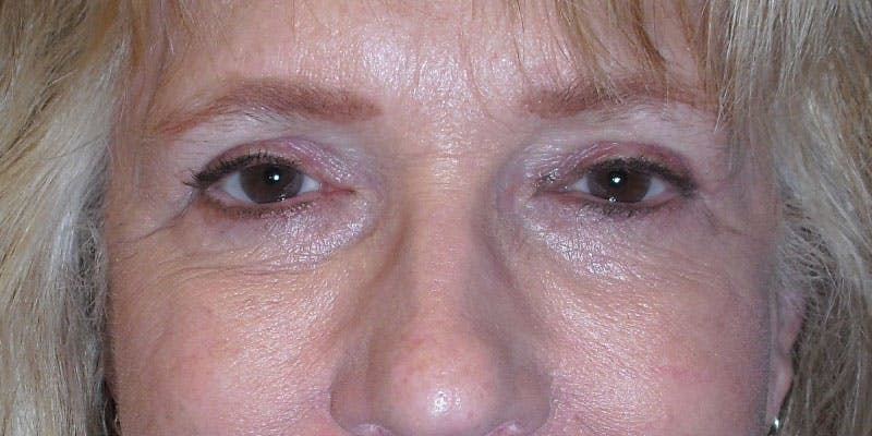 Eyelid Surgery Gallery - Patient 87850543 - Image 2
