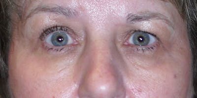 Eyelid Surgery Before & After Gallery - Patient 87850544 - Image 1