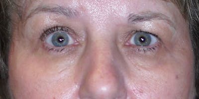 Eyelid Surgery Gallery - Patient 87850544 - Image 1