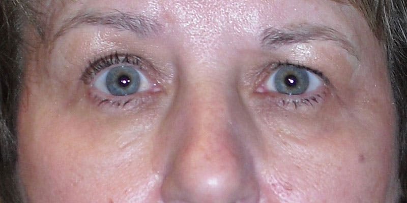 Eyelid Surgery Before & After Gallery - Patient 87850544 - Image 1