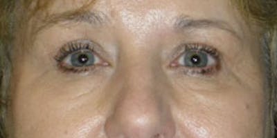 Eyelid Surgery Before & After Gallery - Patient 87850544 - Image 2