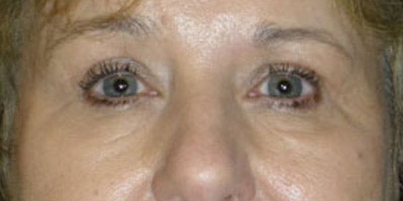 Eyelid Surgery Gallery - Patient 87850544 - Image 2