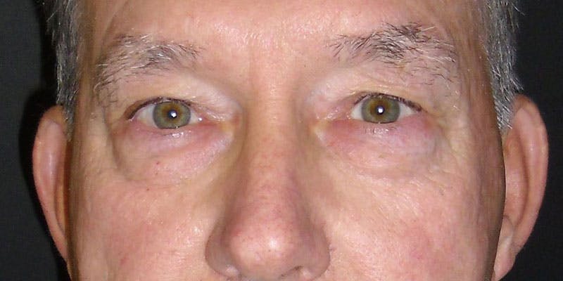 Eyelid Surgery Gallery - Patient 87850545 - Image 1