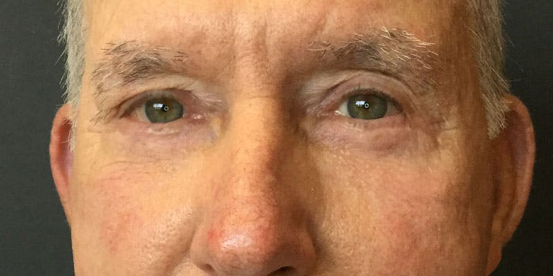 Eyelid Surgery Before & After Gallery - Patient 87850545 - Image 2