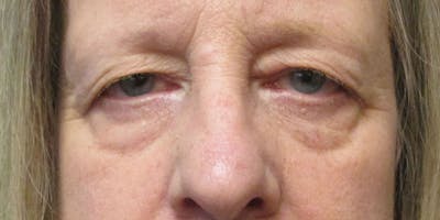 Eyelid Surgery Before & After Gallery - Patient 87850546 - Image 1